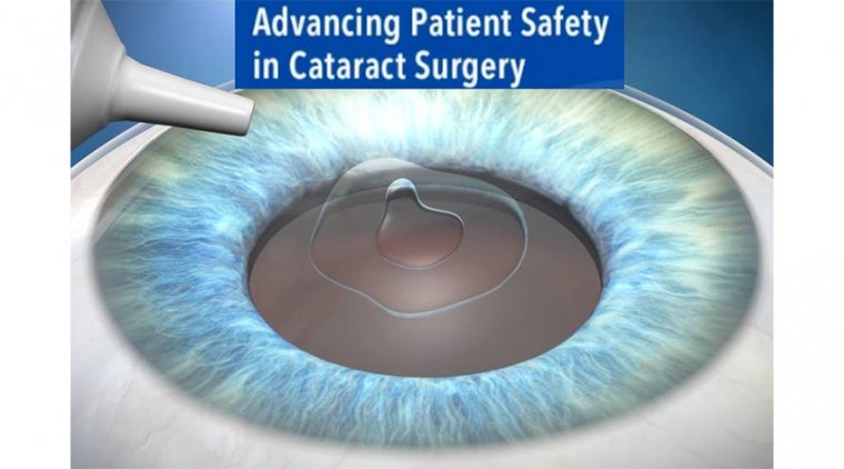 Cataract Surgery Safety