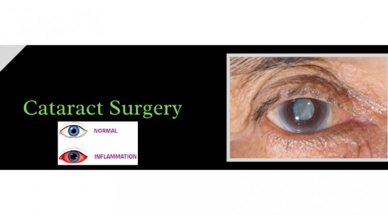 How to Minimize Inflammation After Cataract Surgery