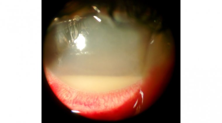 Risk Factors for Developing Endophthalmitis After Cataract Surgery