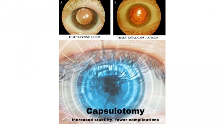 The Capsulotomy