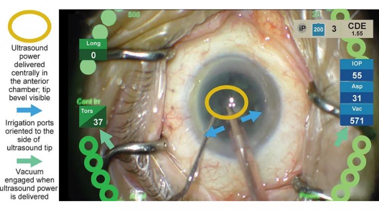 The Surgical Accuracy and Efficiency with Femtosecond Laser-Assisted Cataract Surgery