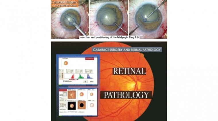 PDF) Modified Malyugin ring iris expansion technique in small-pupil cataract  surgery with posterior capsule defect | Kumaraguru Kathirvel - Academia.edu